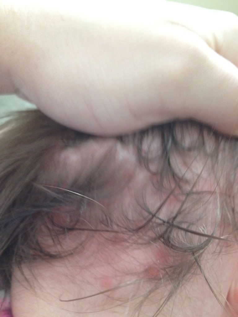 flea bites on scalp #9