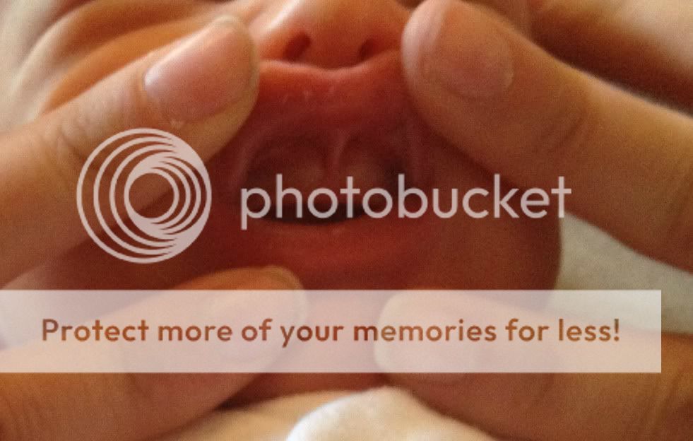 Lip tie? BabyCenter
